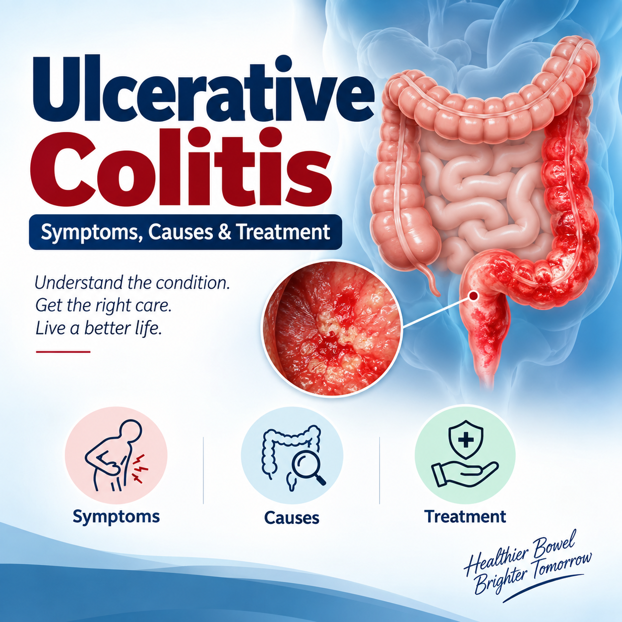Ulcerative colitis symptoms causes and treatment in Lucknow